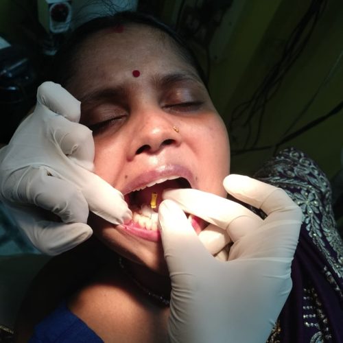 11. Root canal treatment ( RCT)