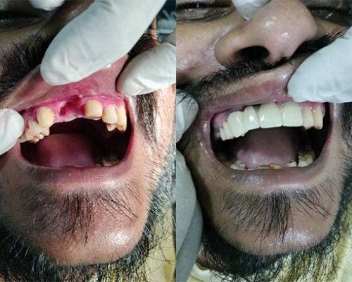 Close Up of using shade guide at woman's mouth to check veneer of tooth crown