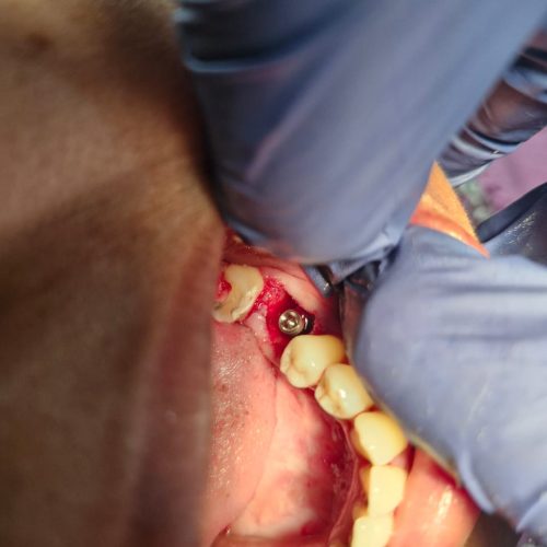 3.Missing teeth rehabilitation using Dental Implants-2