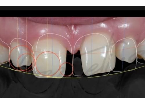 Laminates n veneers