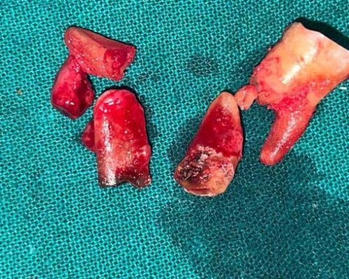 Close Up of using shade guide at woman's mouth to check veneer of tooth crown