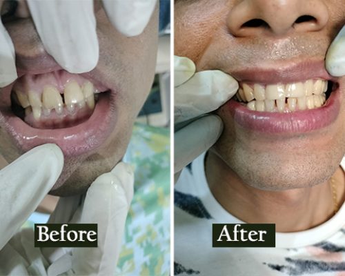 gap-closure-after